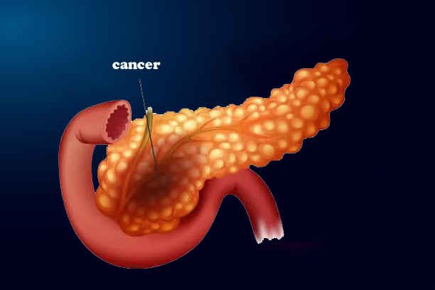 Pancreatic Cancer Treatment