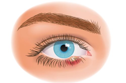 Chalazion Treatment above of the Page
