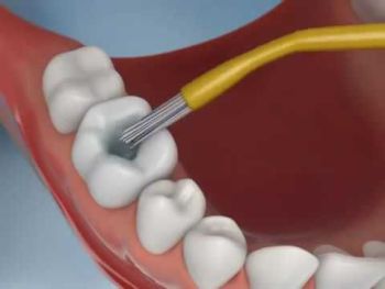 Dental Filling above of the Page