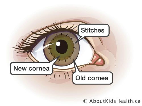 Corneal Transplant Surgery above of the Page