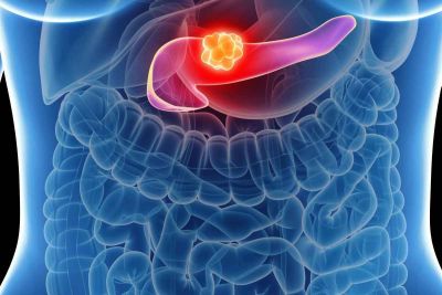 Pancreatic Cancer Treatment above of the Page