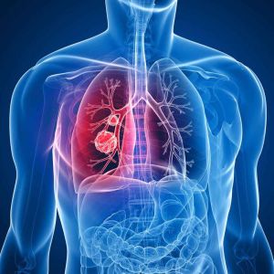 Lung Cancer Treatment above of the Page
