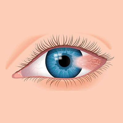 Pterygium surgery above of the Page