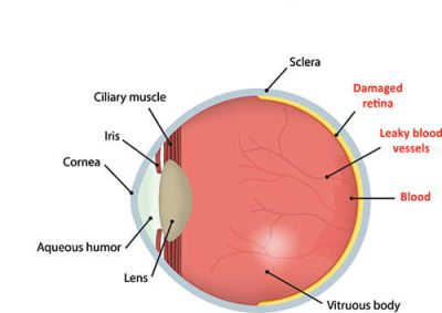 Diabetic Retinopathy Treatment above of the Page