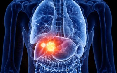 Liver Cancer Treatment above of the Page