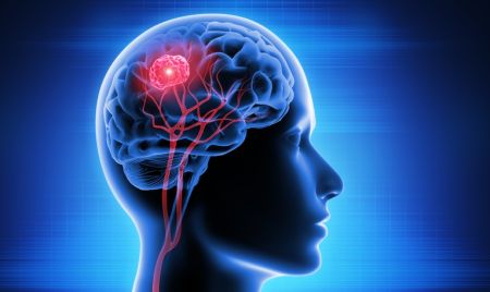 Brain Cancer Treatment above of the Page