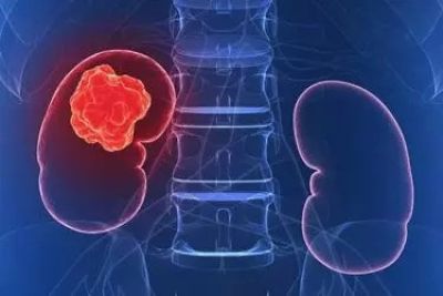 Kidney Cancer Treatment above of the Page